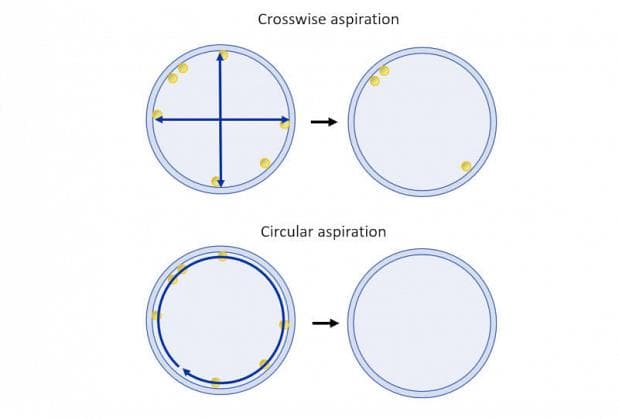 circular-aspiration